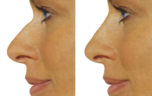 коррекция носа при помощи инъекций гиалуроновой кислоты