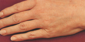 Биоармирование кистей рук