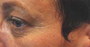 Биоармирование кожи вокруг глаз