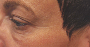Биоармирование кожи вокруг глаз