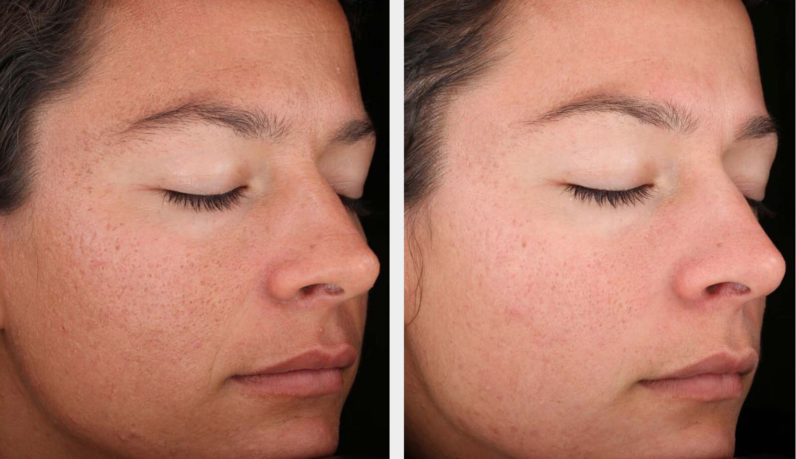 обновление кожи - фото до и после биоревитализации